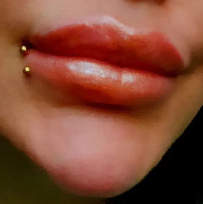 آفر تزرریقات ژل و بوتاکس فشیال - تصویر 8