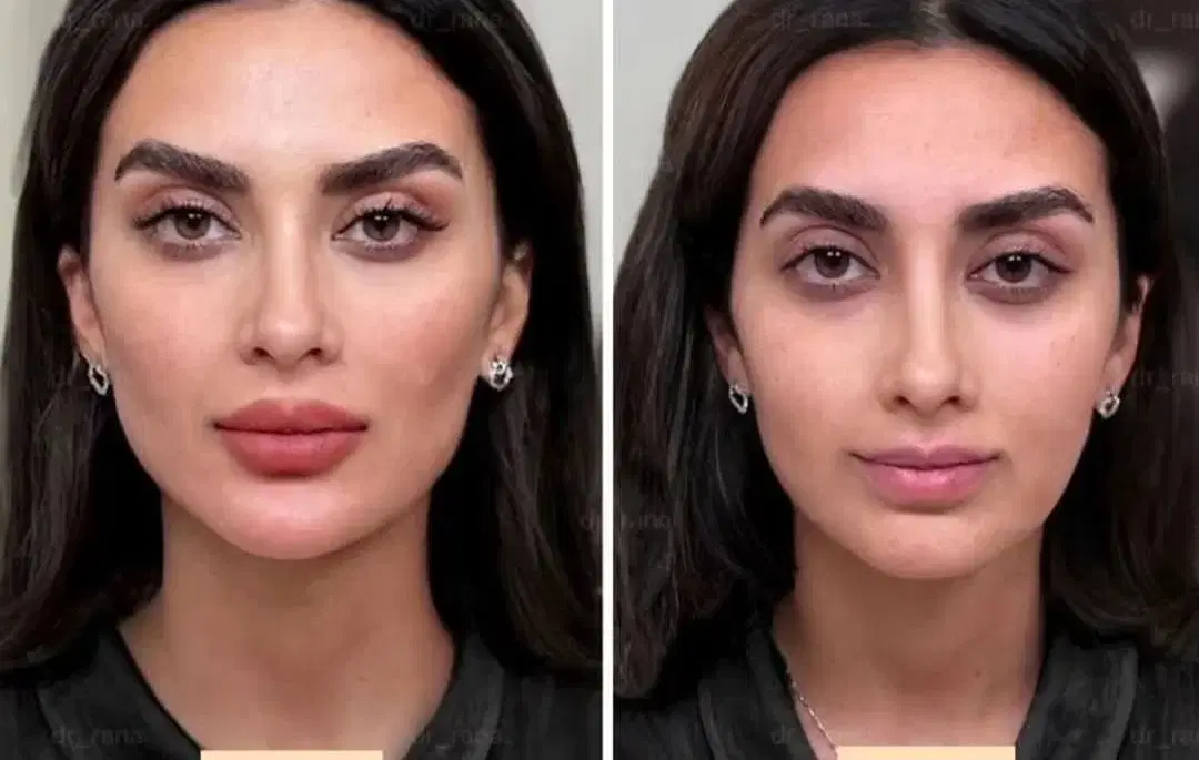آفر تزرریقات ژل و بوتاکس فشیال